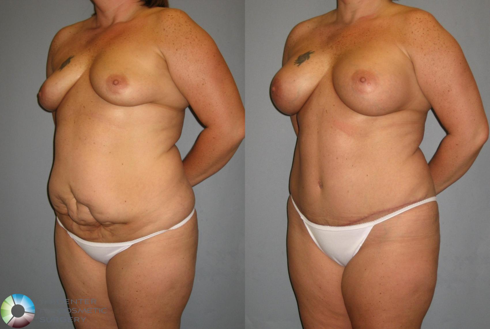 Before & After Mommy Makeover Case 354 View #2 in Denver and Colorado Springs, CO