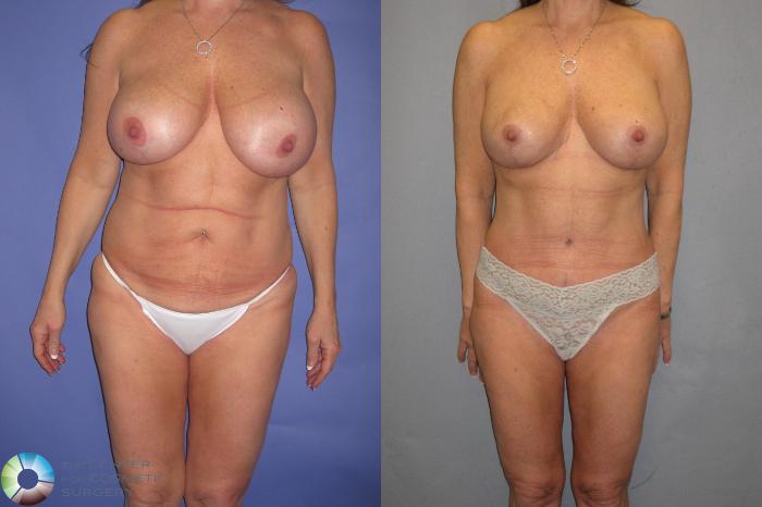 Before & After Tummy Tuck Case 366 View #1 View in Golden, CO