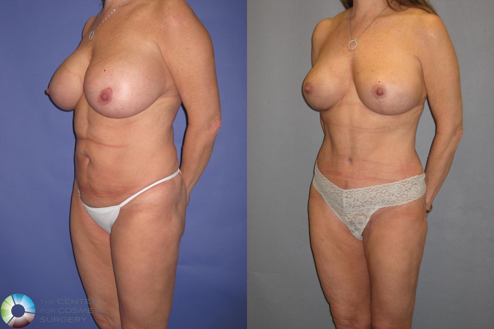 Before & After Mommy Makeover Case 366 View #2 in Denver and Colorado Springs, CO