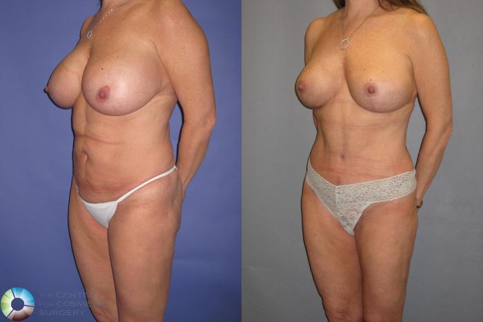 Before & After Tummy Tuck Case 366 View #2 View in Golden, CO