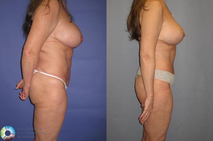 Before & After Breast Lift Case 366 View #3 View in Golden, CO