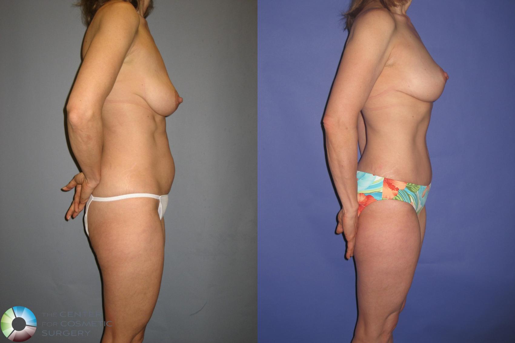 Before & After Mommy Makeover Case 367 View #3 in Denver and Colorado Springs, CO