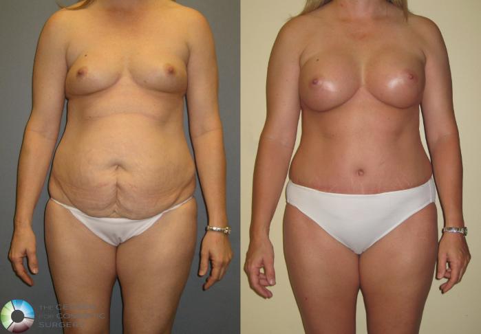 Before & After Breast Augmentation Case 373 View #1 in Denver and Colorado Springs, CO
