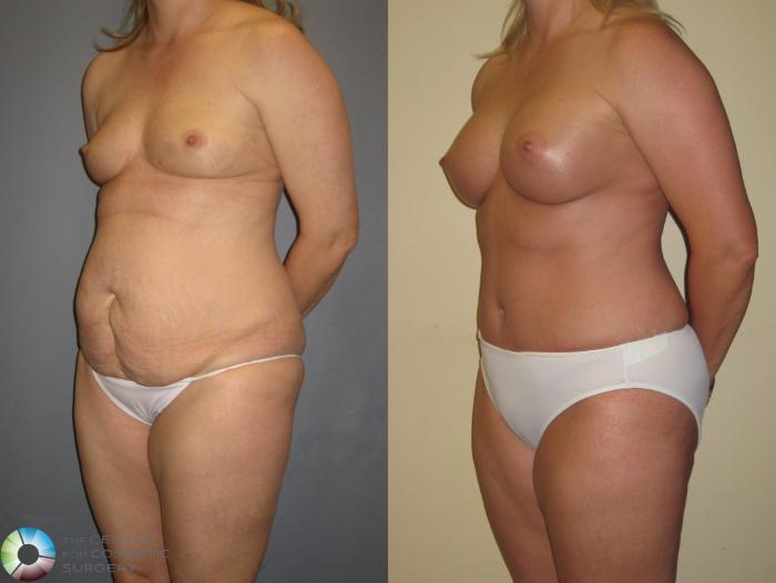 Before & After Tummy Tuck Case 373 View #2 in Denver and Colorado Springs, CO
