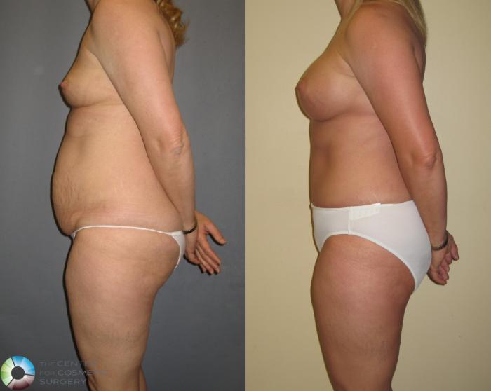 Before & After Breast Augmentation Case 373 View #3 in Denver and Colorado Springs, CO