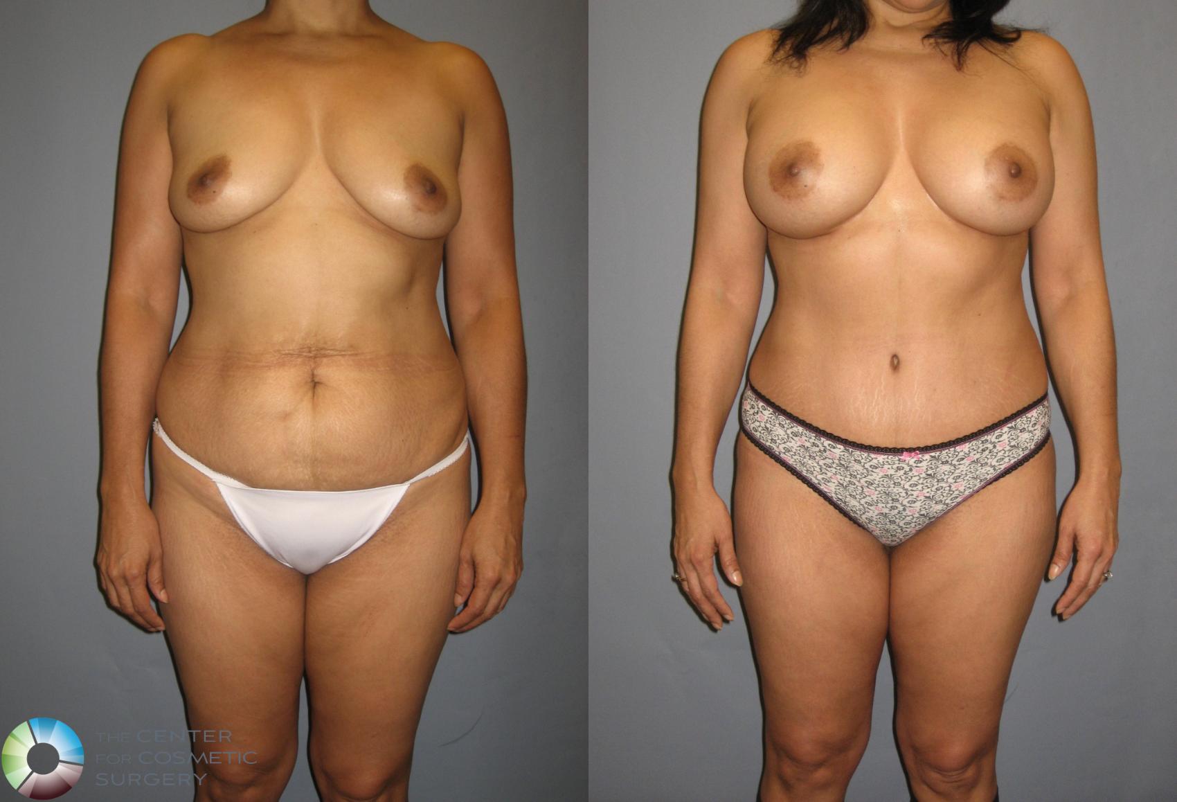 Before & After Mommy Makeover Case 374 View #1 in Denver and Colorado Springs, CO