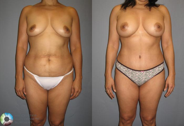 Before & After Breast Augmentation Case 374 View #1 View in Golden, CO