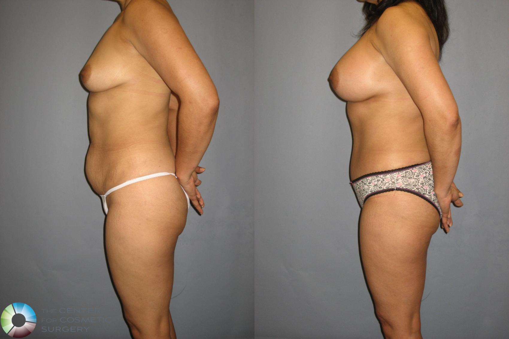 Before & After Liposuction Case 374 View #2 View in Denver & Golden, CO
