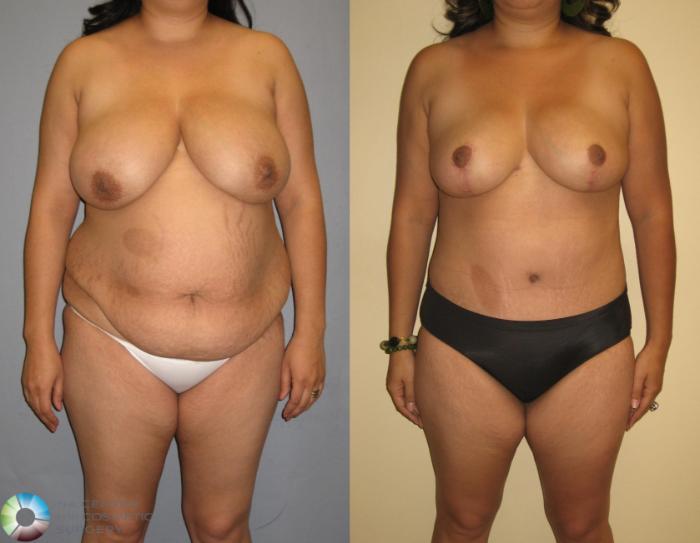 Before & After Power-assisted Liposuction Case 377 View #1 in Denver, CO