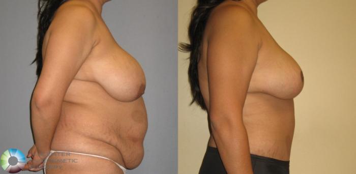 Before & After Breast Reduction Case 377 View #2 in Denver and Colorado Springs, CO