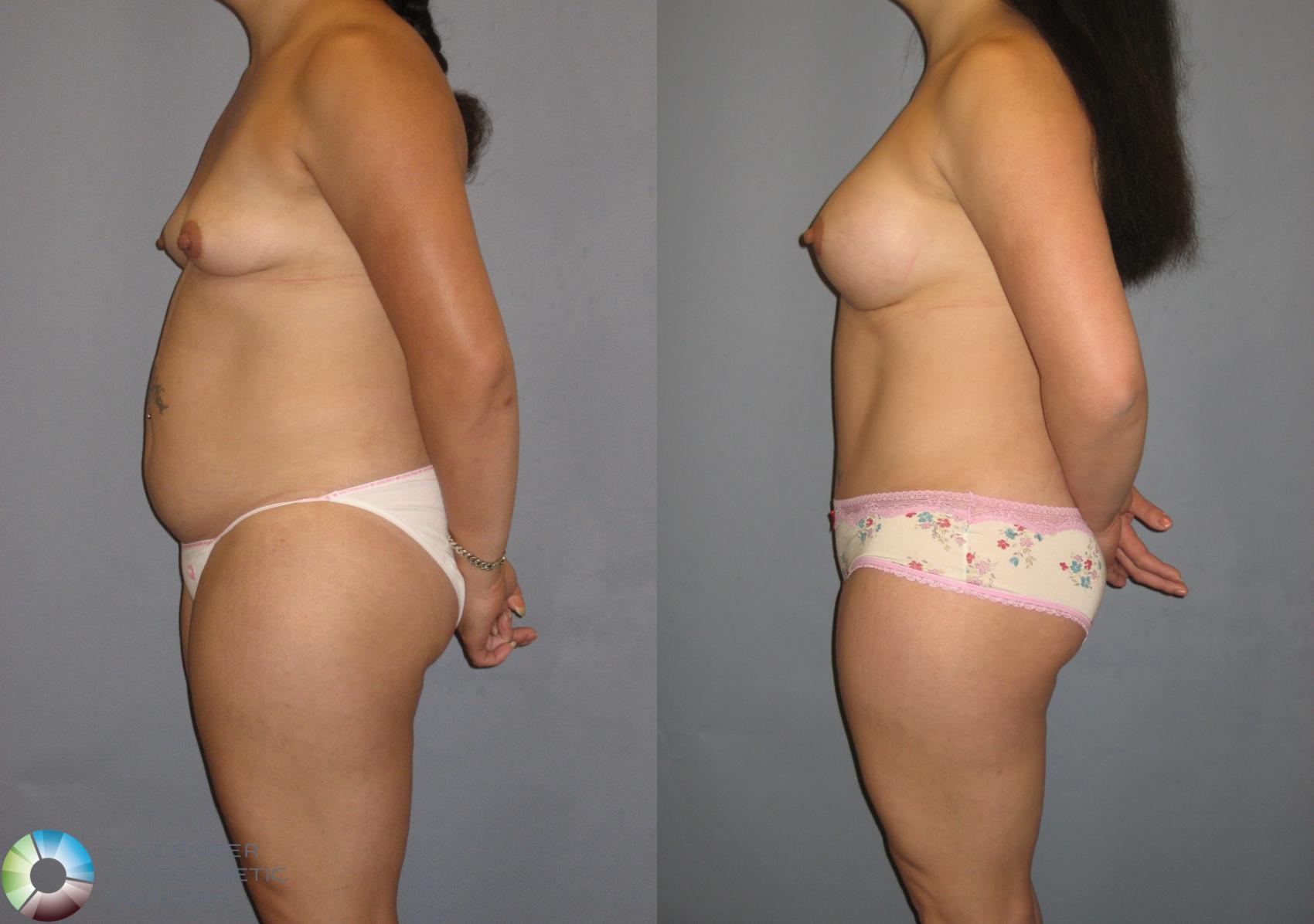 Before & After Mommy Makeover Case 378 View #2 in Denver and Colorado Springs, CO