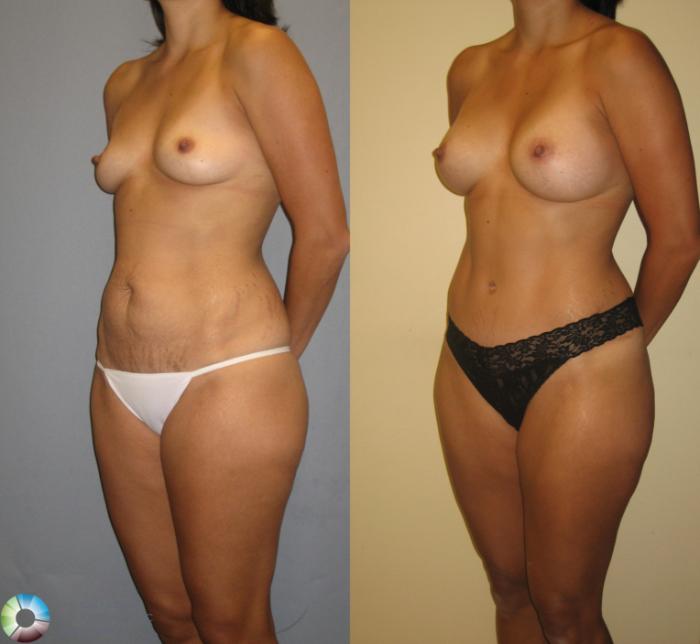 Before & After Breast Augmentation Case 382 View #1 View in Golden, CO