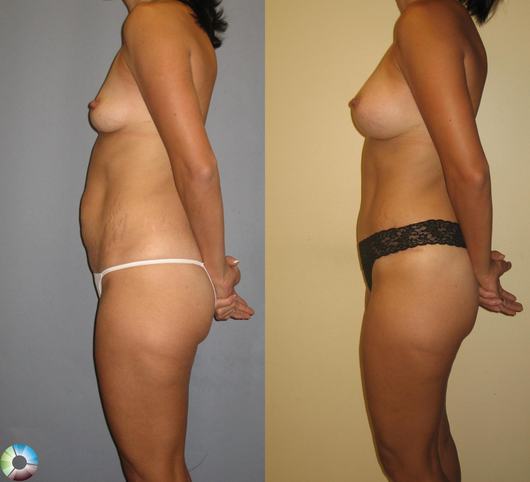 Before & After Mommy Makeover Case 382 View #4 View in Golden, CO