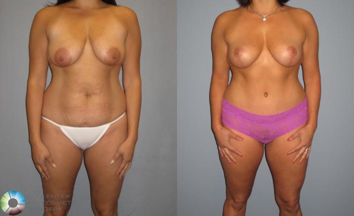 Before & After Breast Lift without Implants Case 392 View #1 View in Golden, CO