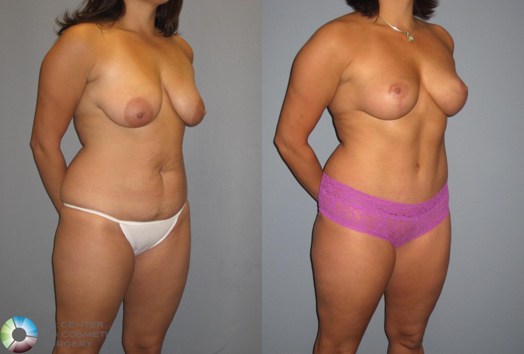 Before & After Breast Lift without Implants Case 392 View #2 in Denver and Colorado Springs, CO