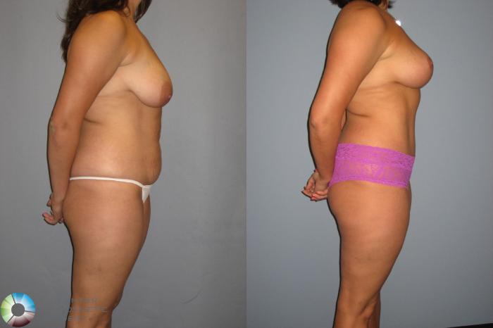 Before & After Breast Lift without Implants Case 392 View #3 View in Golden, CO