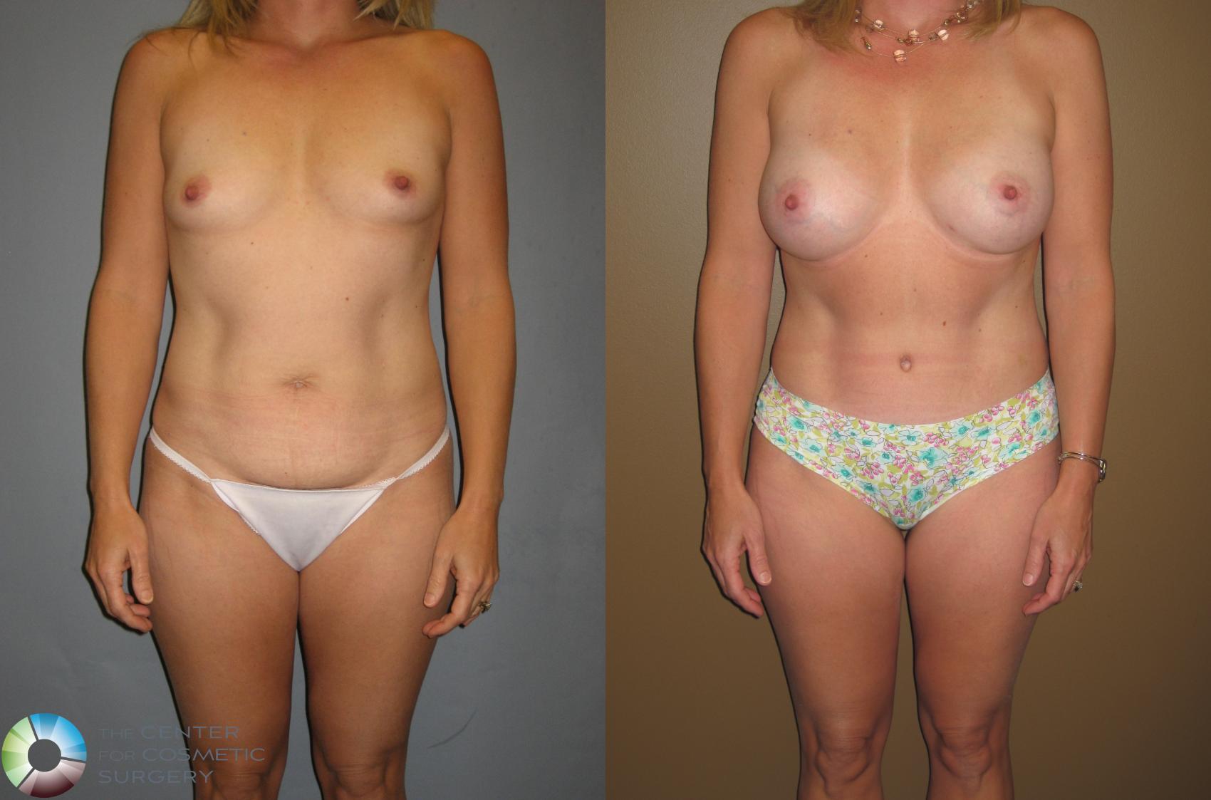 Before & After Breast Augmentation Case 393 View #1 in Denver and Colorado Springs, CO