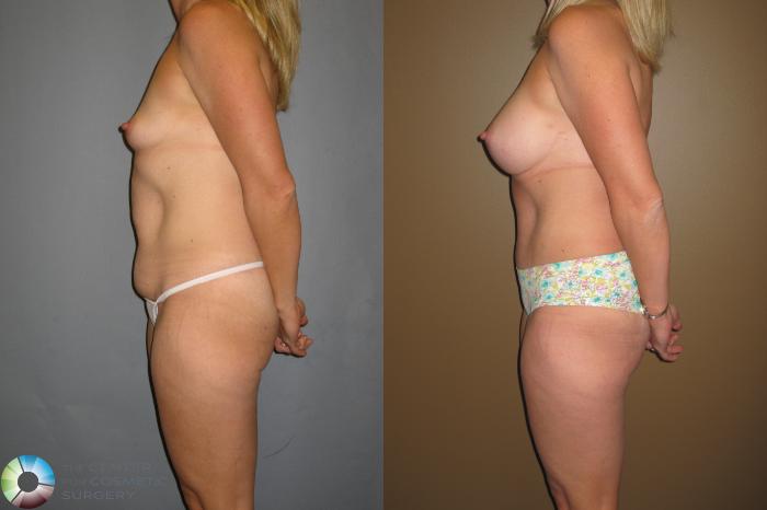 Before & After Tummy Tuck Case 393 View #2 View in Golden, CO