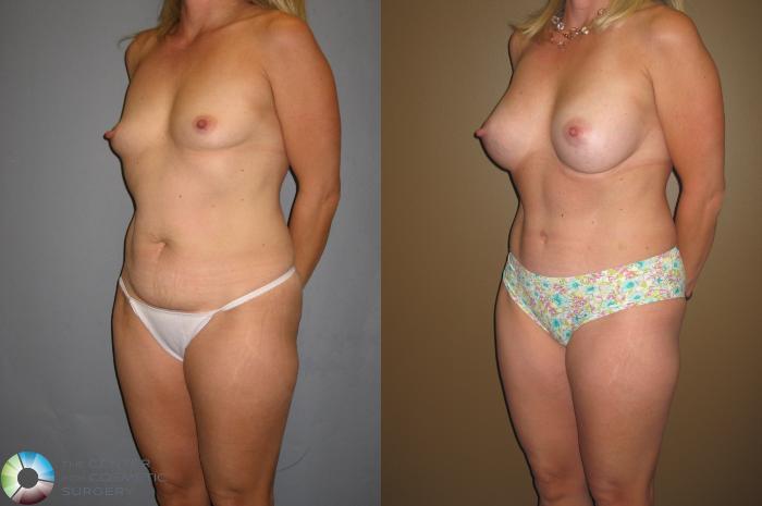 Before & After Tummy Tuck Case 393 View #3 View in Golden, CO