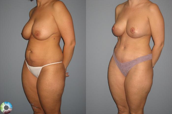 Before & After Breast Lift Case 401 View #1 View in Golden, CO