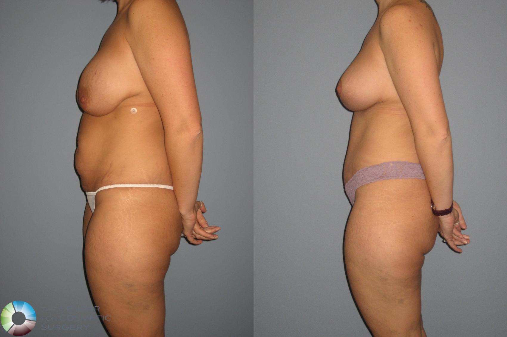Before & After Mommy Makeover Case 401 View #2 in Denver and Colorado Springs, CO