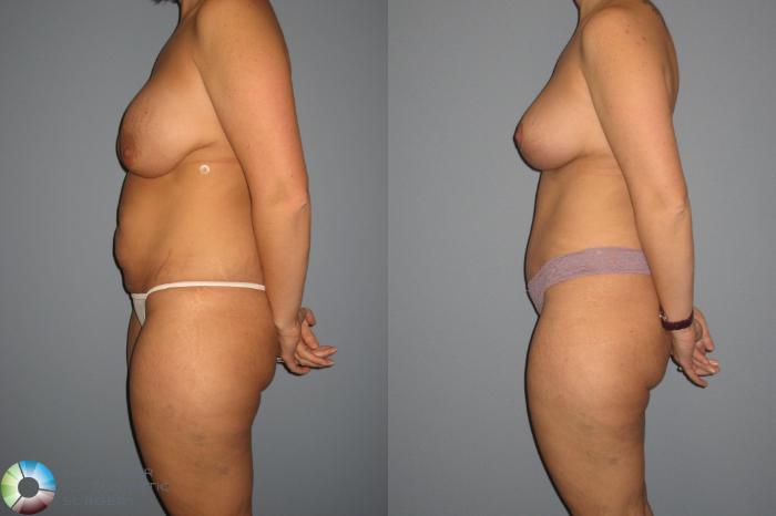Before & After Breast Lift Case 401 View #2 View in Golden, CO
