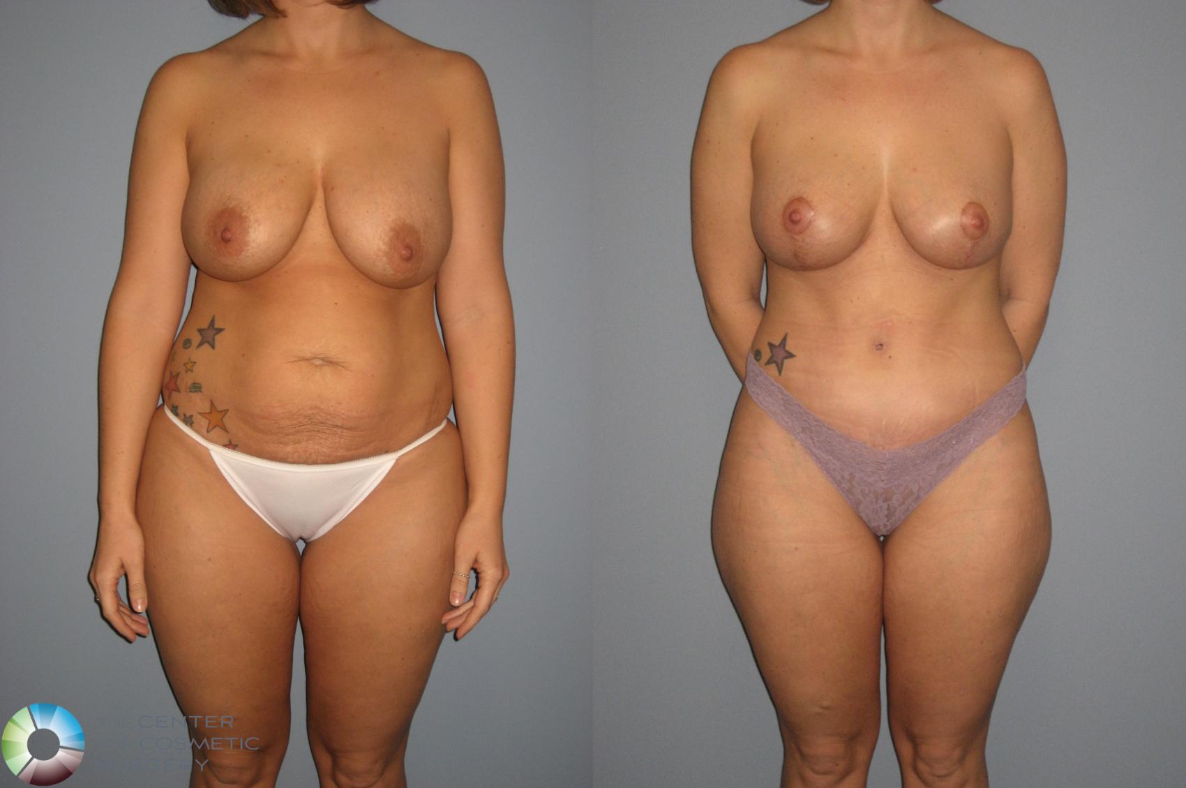 Before & After Mommy Makeover Case 401 View #3 in Denver and Colorado Springs, CO