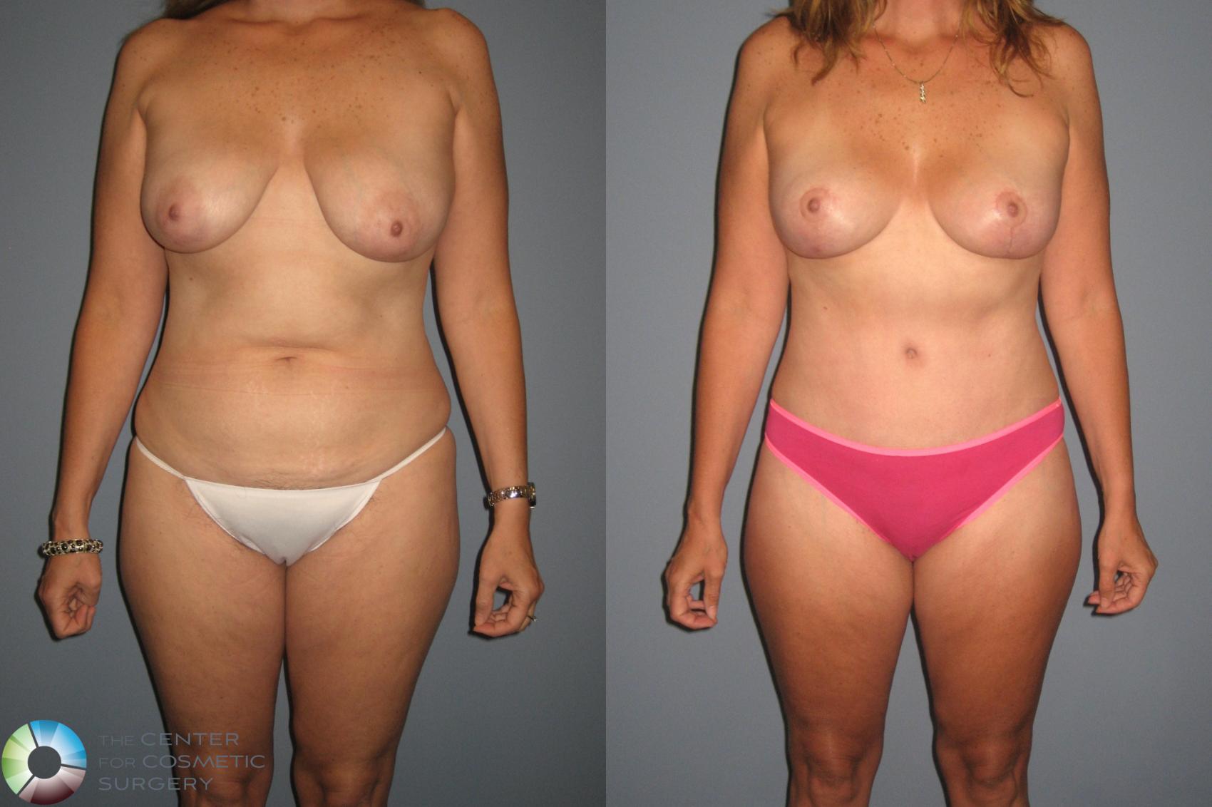 Before & After Tummy Tuck Case 409 View #1 in Denver, CO