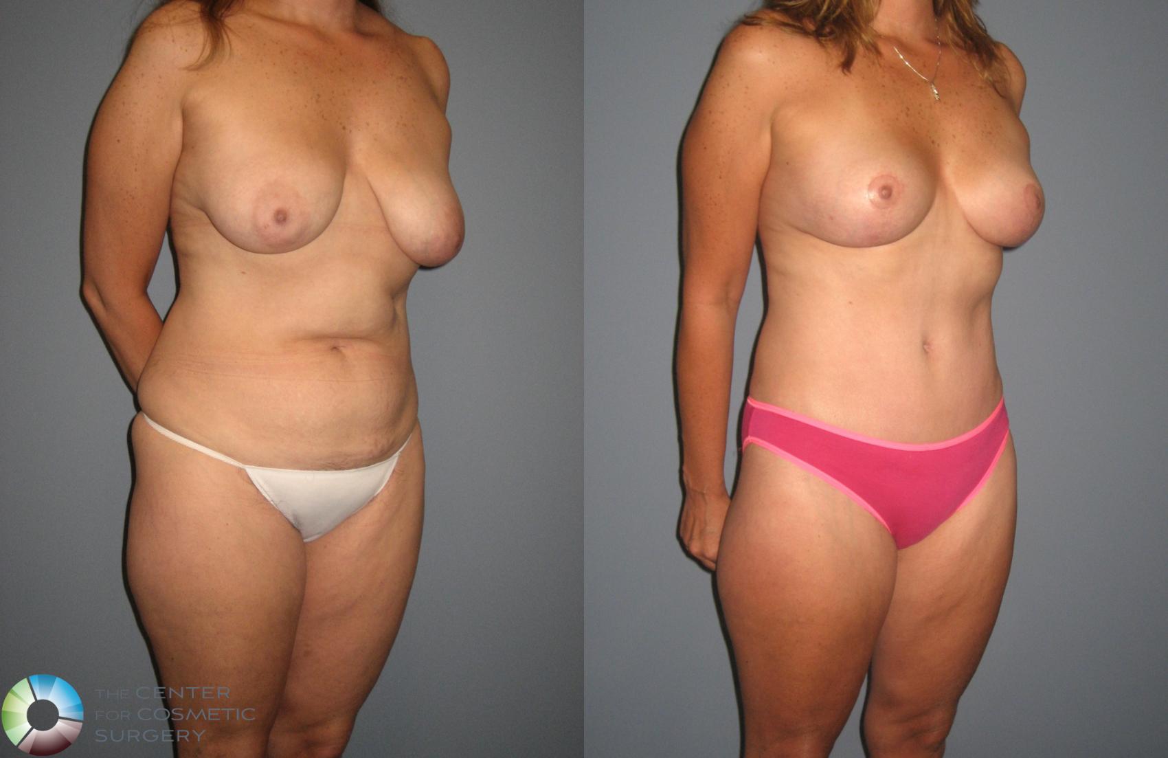 Before & After Mommy Makeover Case 409 View #2 in Denver and Colorado Springs, CO