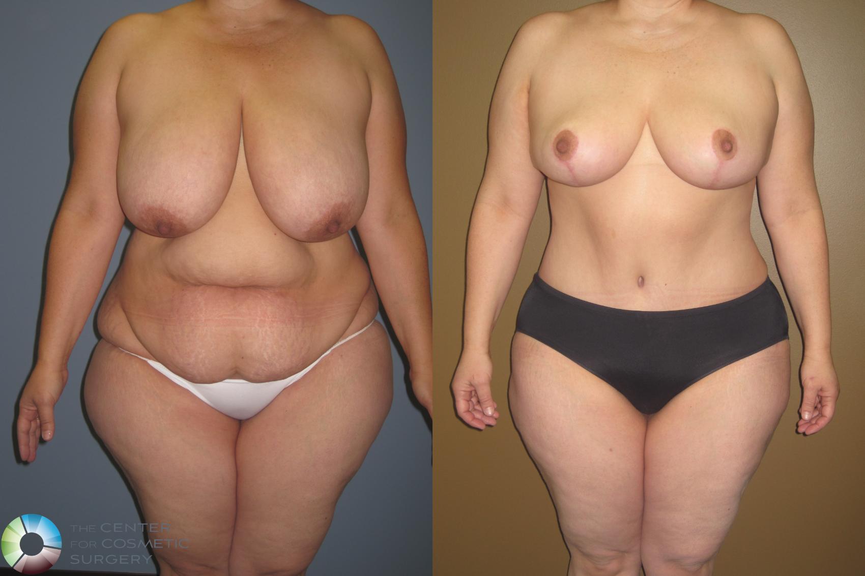 Before & After Breast Reduction Case 413 View #1 in Denver and Colorado Springs, CO