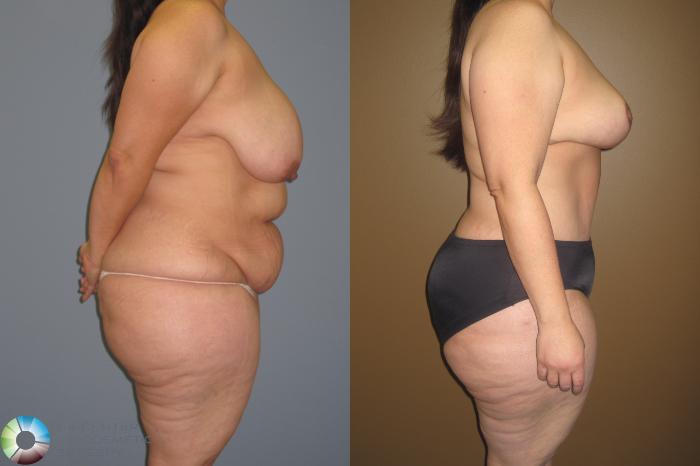 Before & After Breast Reduction Case 413 View #2 View in Golden, CO