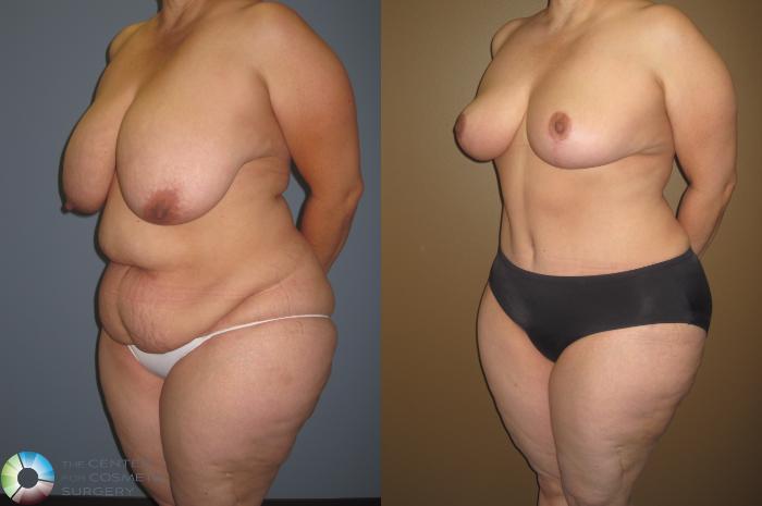 Before & After Breast Reduction Case 413 View #3 View in Golden, CO