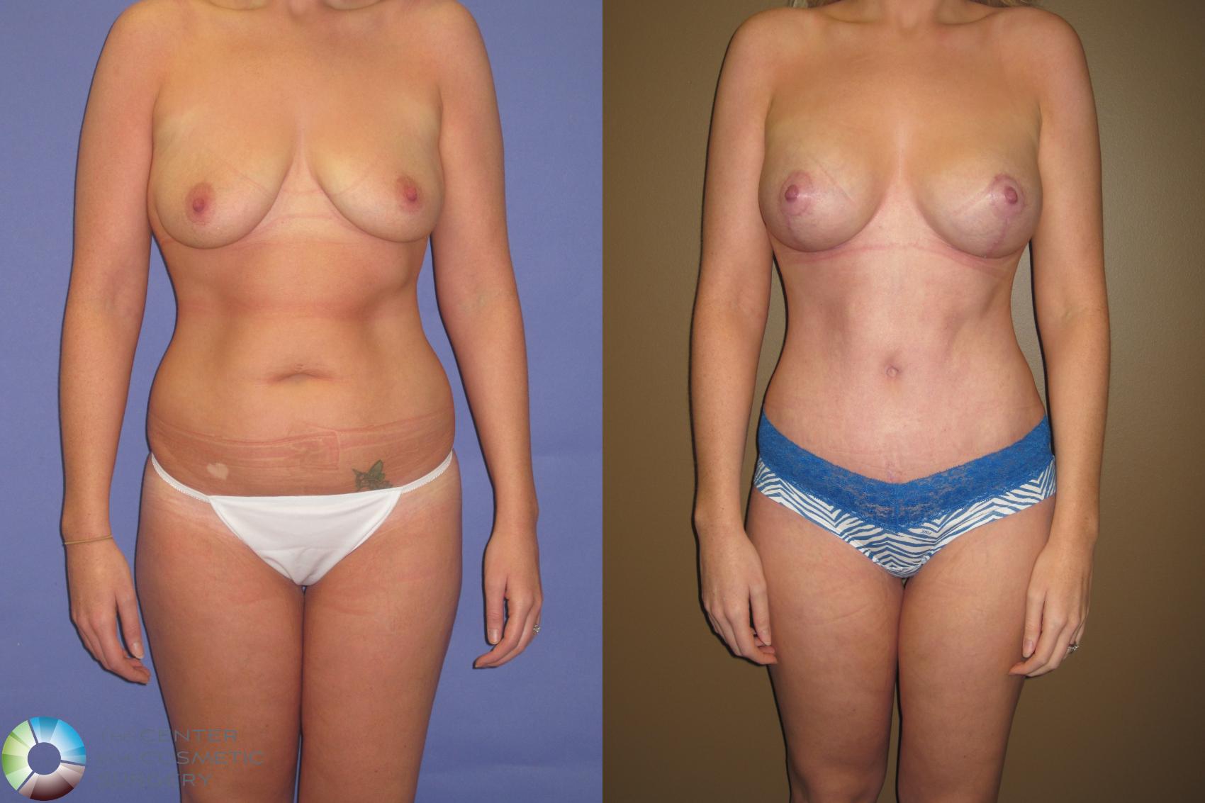 Before & After Breast Lift Case 415 View #1 in Denver and Colorado Springs, CO