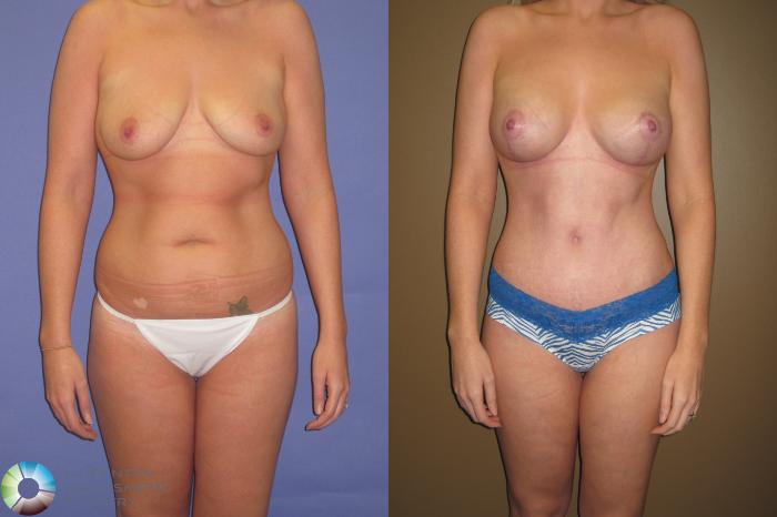 Before & After Tummy Tuck Case 415 View #1 View in Golden, CO