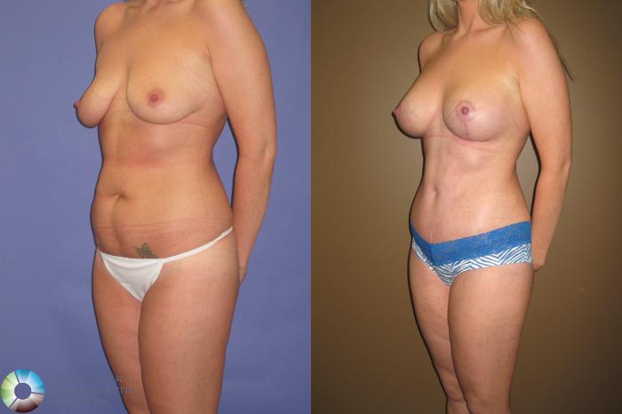 Before & After Tummy Tuck Case 415 View #2 View in Golden, CO