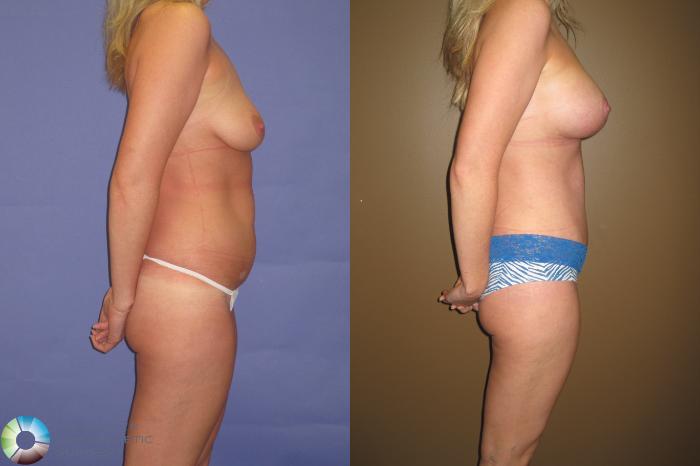 Before & After Tummy Tuck Case 415 View #3 View in Golden, CO