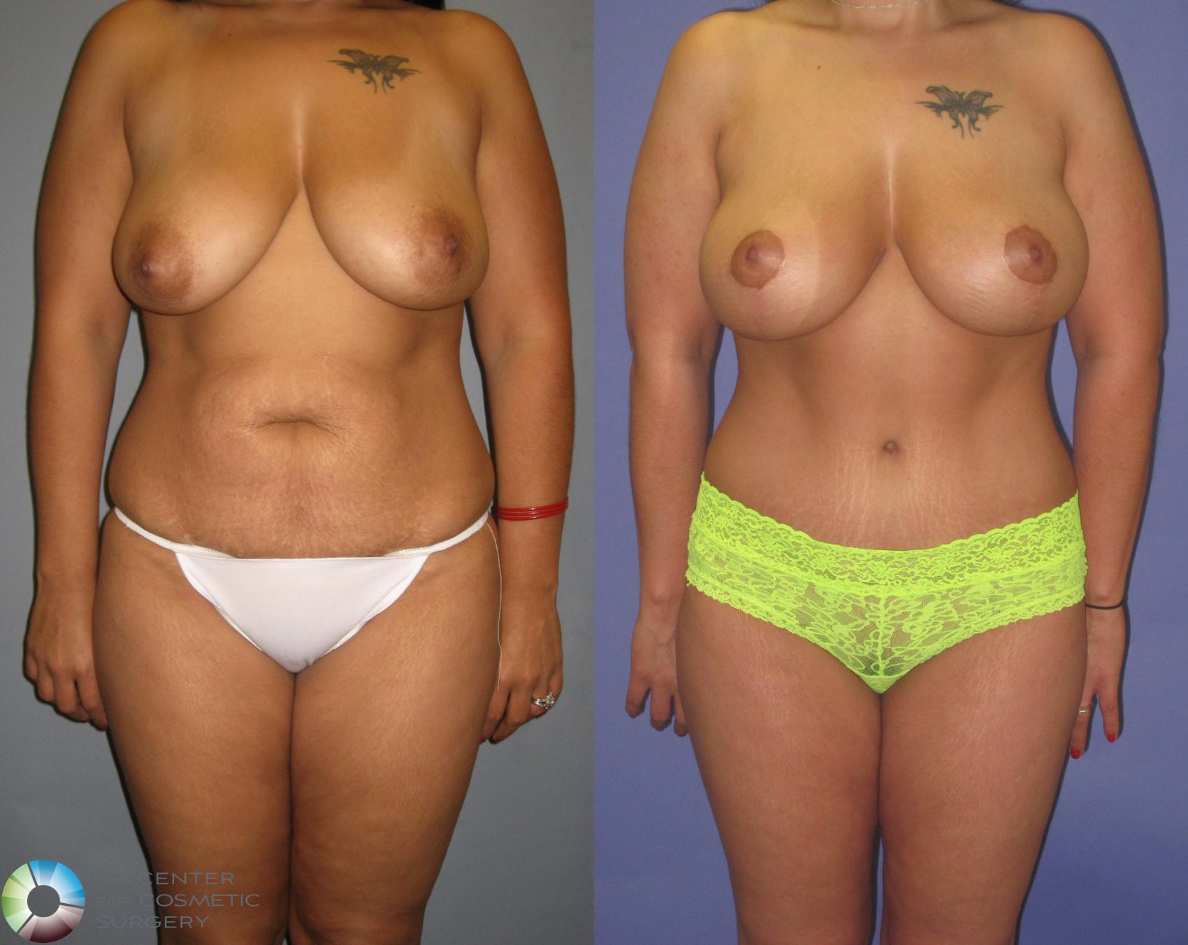 Before & After Tummy Tuck Case 417 View #1 View in Denver & Golden, CO