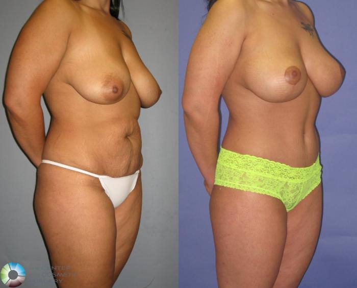 Before & After Tummy Tuck Case 417 View #2 View in Golden, CO