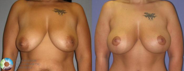Before & After Tummy Tuck Case 417 View #3 View in Golden, CO