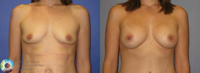 Before & After Tummy Tuck Case 418 View #1 View in Golden, CO