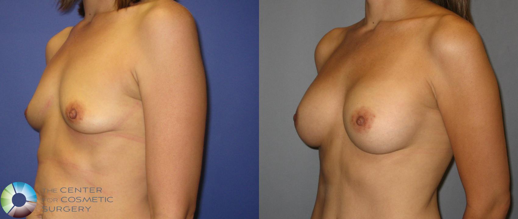 Before & After Mommy Makeover Case 418 View #2 View in Golden, CO