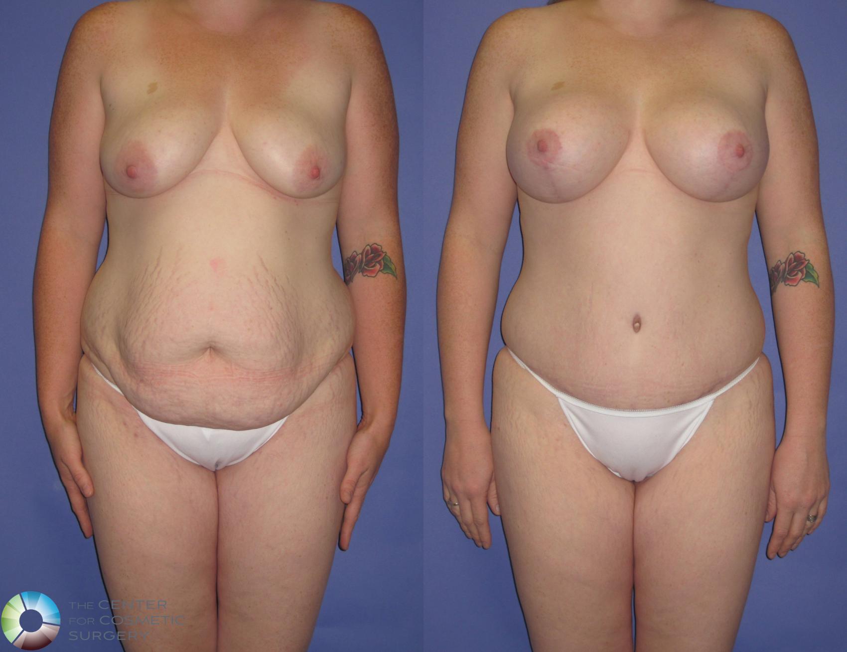 Before & After Breast Augmentation Case 420 View #1 in Denver, CO