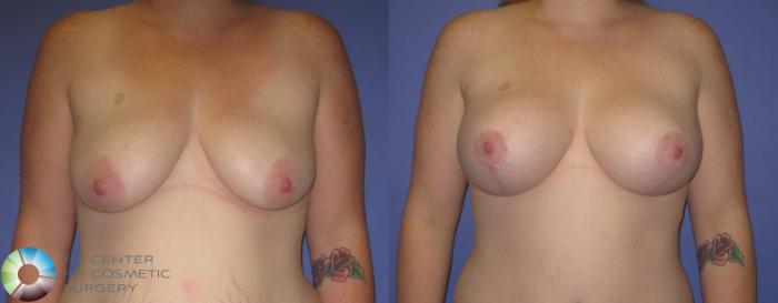 Before & After Breast Augmentation Case 420 View #2 View in Golden, CO