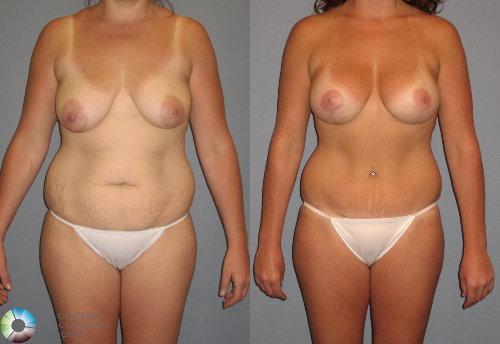 Before & After Tummy Tuck Case 425 View #1 View in Golden, CO