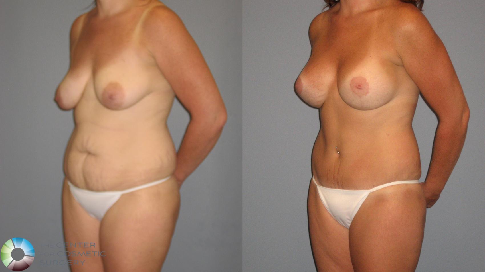 Before & After Mommy Makeover Case 425 View #2 in Denver and Colorado Springs, CO