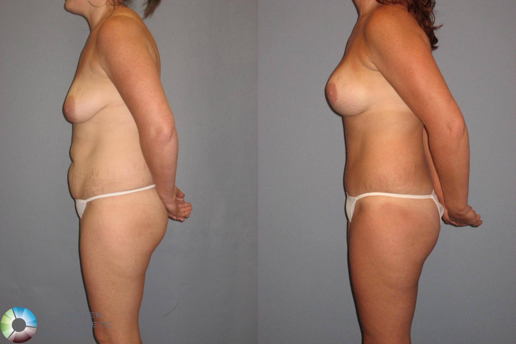 Before & After Mommy Makeover Case 425 View #3 in Denver and Colorado Springs, CO