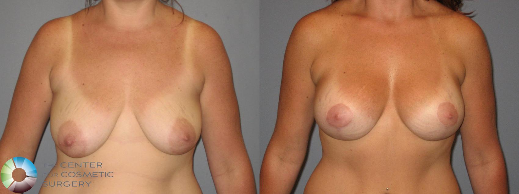 Before & After Mommy Makeover Case 425 View #4 in Denver and Colorado Springs, CO