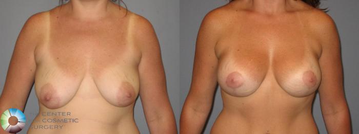 Before & After Tummy Tuck Case 425 View #4 View in Golden, CO