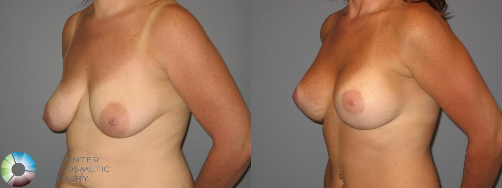 Before & After Mommy Makeover Case 425 View #5 in Denver and Colorado Springs, CO