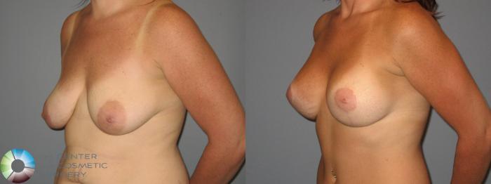 Before & After Tummy Tuck Case 425 View #5 View in Golden, CO